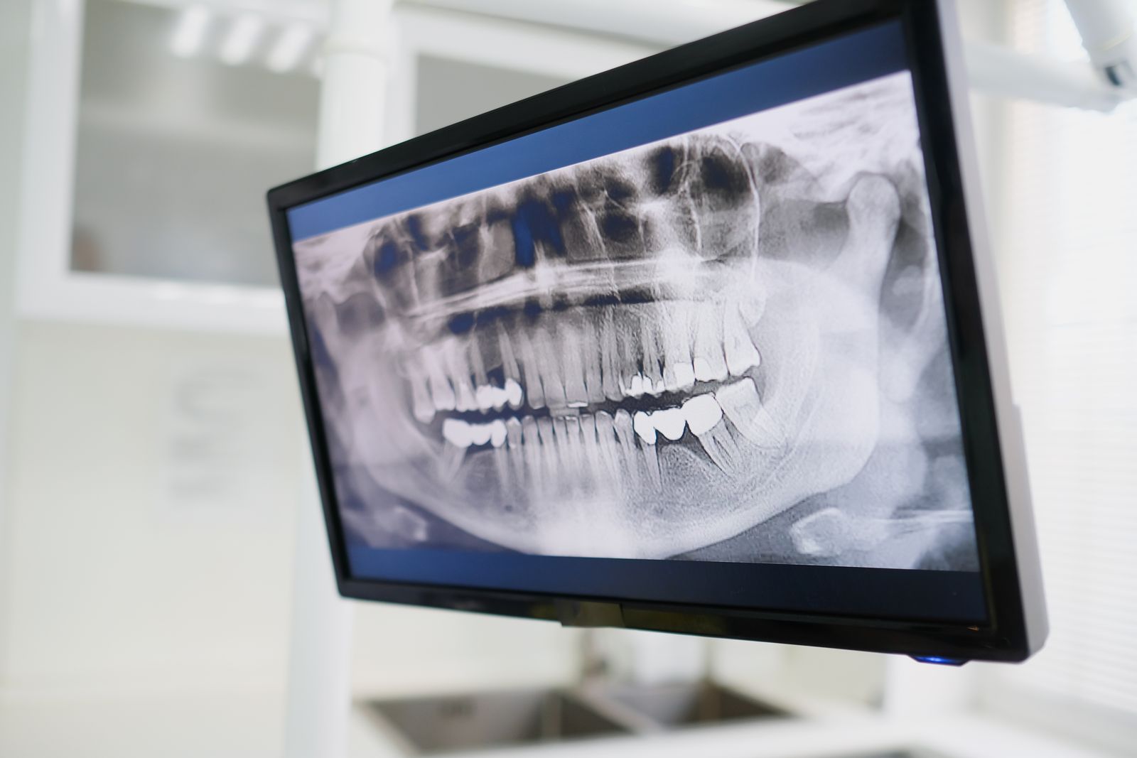 A panoramic dental X-ray on a monitor